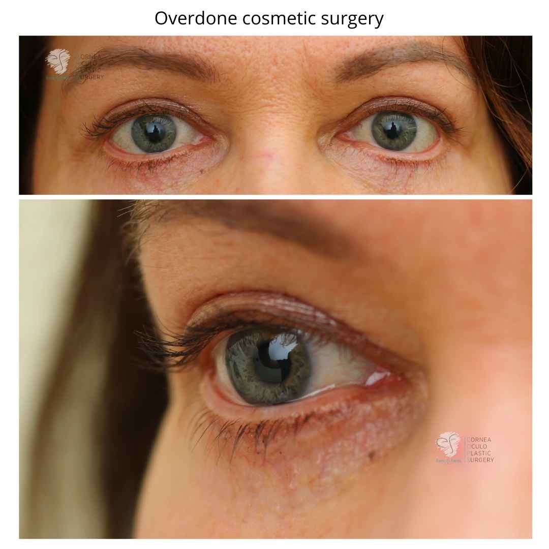 Showing cosmetic surgery that is overdone. This lady suffers symptoms of dry eye as a result of another surgeon performing surgery and overdoing it. 