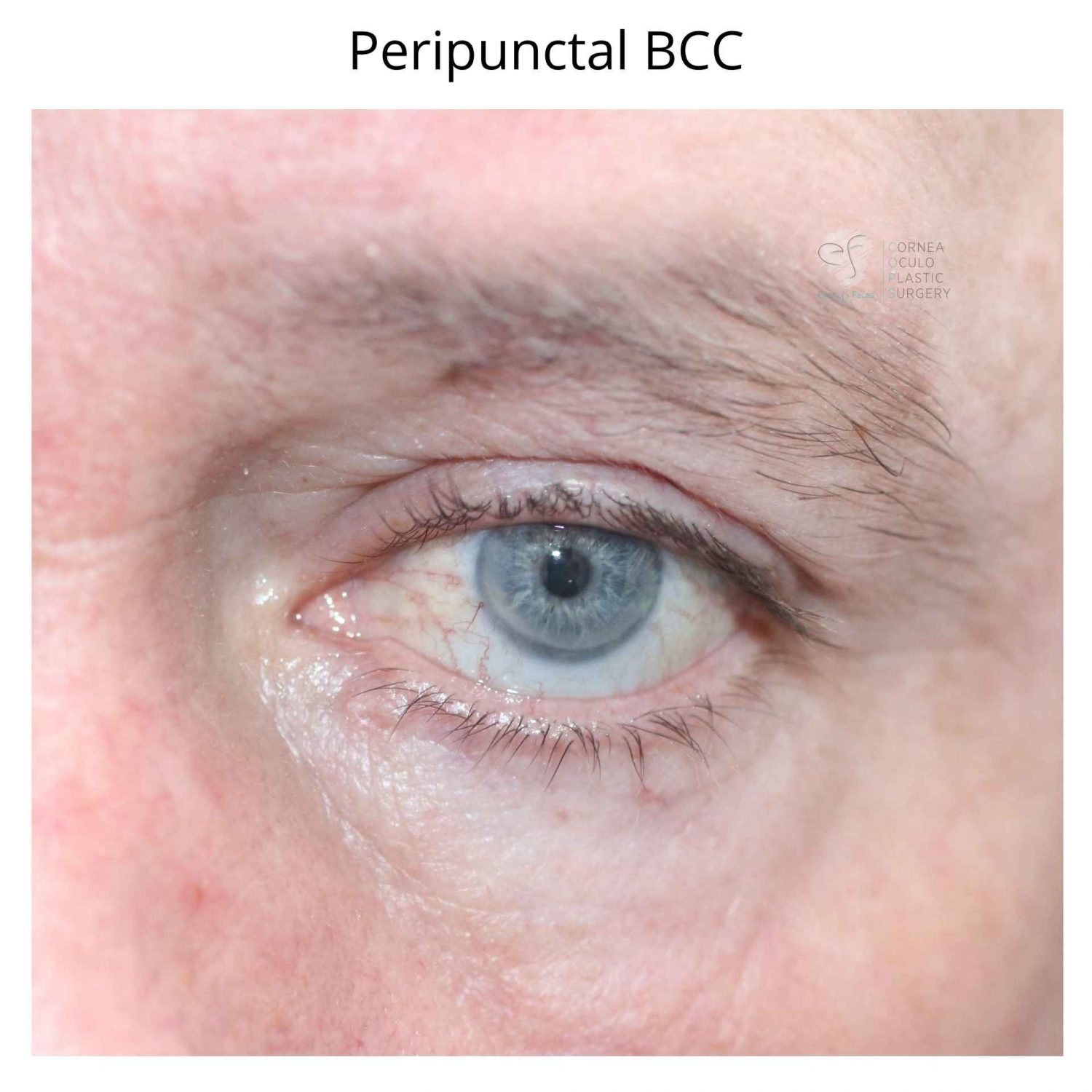 Peripunctal BCC - this shows a lump on the lower eyelid just near the peripunctum.