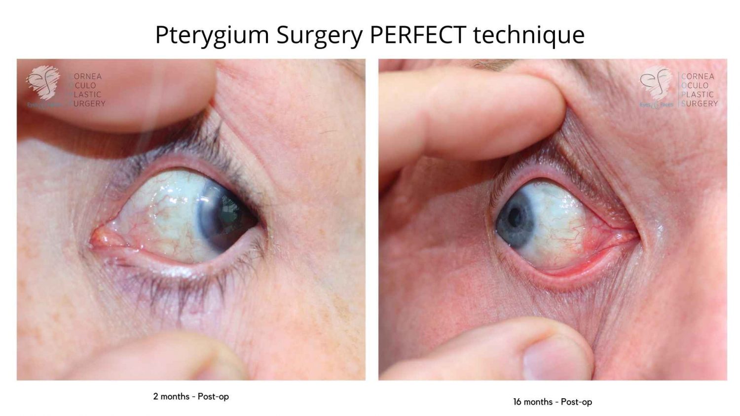 PERFECT pterygium surgery, this technique is used for optimal results post operatively. This shows results at 2 months and 16 months post PERFECT pterygium surgery.