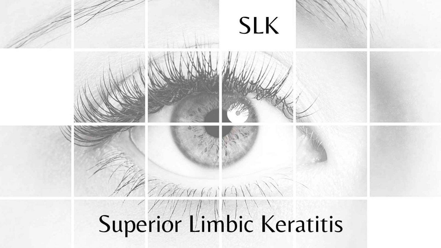 Superior Limbic Keratitis - SLK