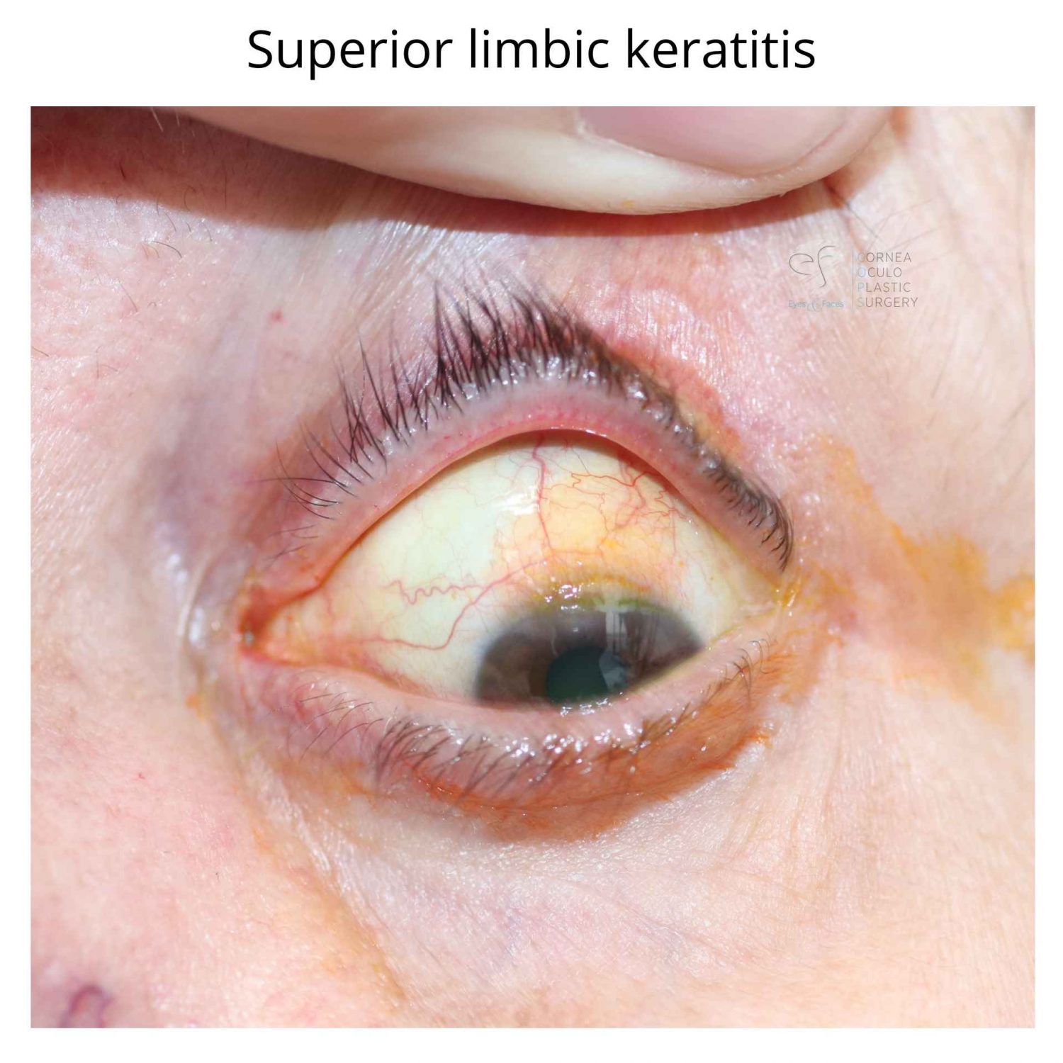Superior Limbic Keratitis SLK 