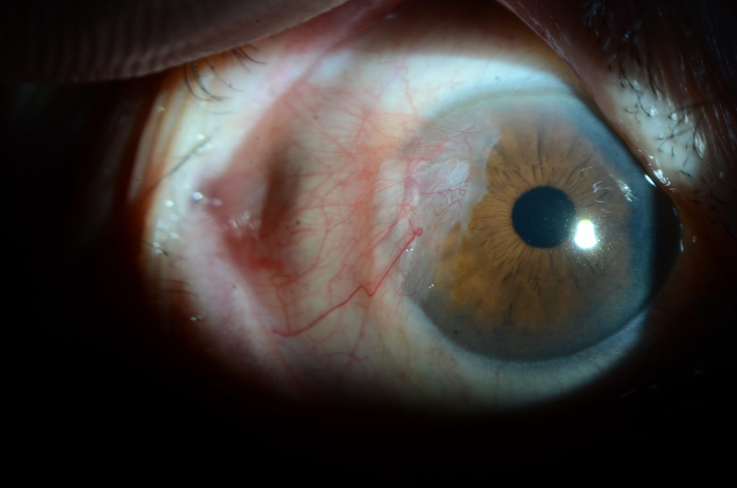 Temporal pterygium growing over the cornea. This has followed after having cataract surgery.
