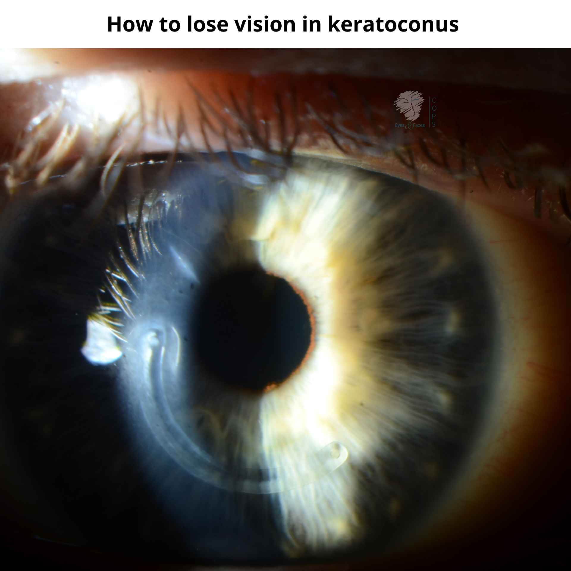 Losing vision in keratoconus with Intacs. See the plastic ring in the eye, that is Intacs.