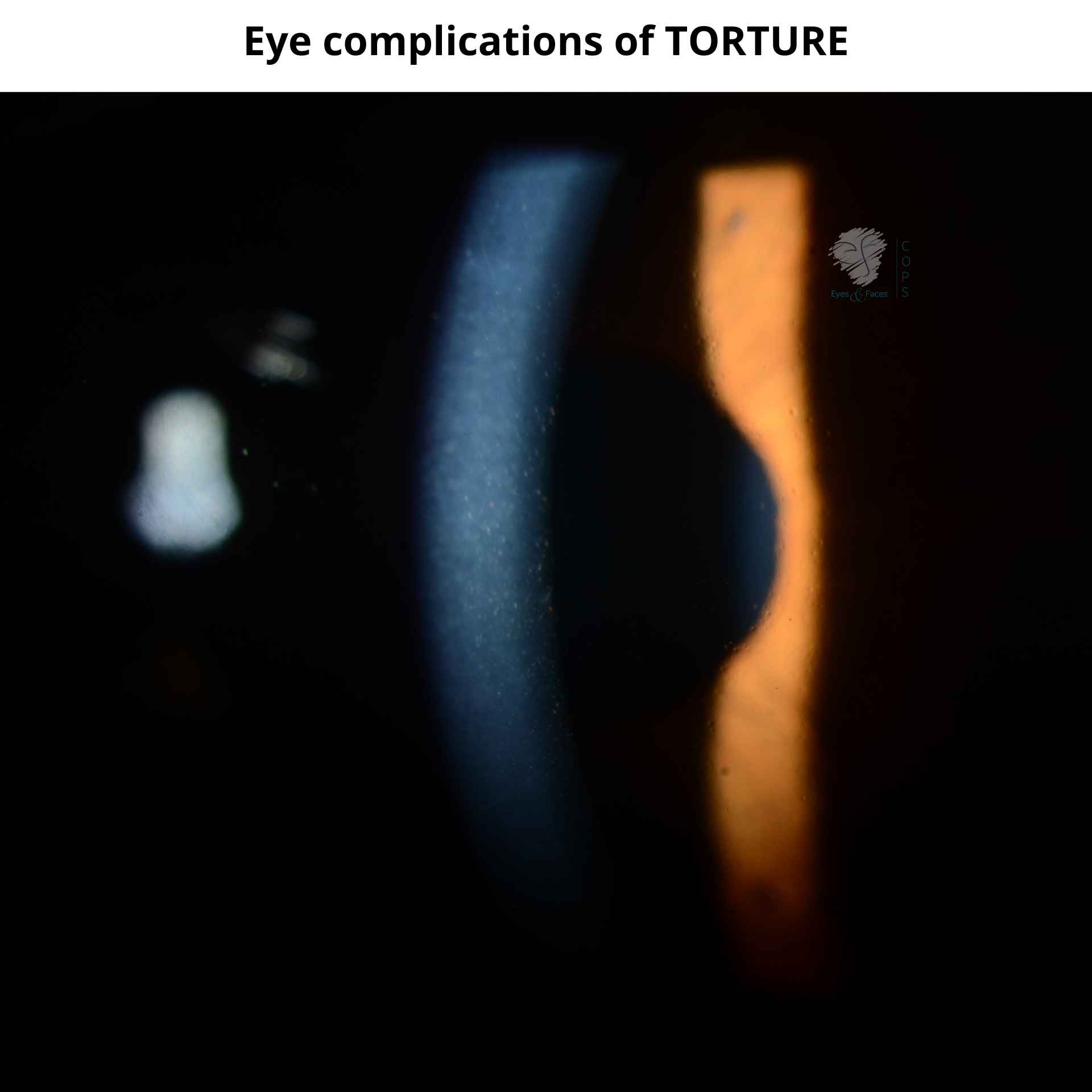 Eye complications of torture leading to damage of the cornea.