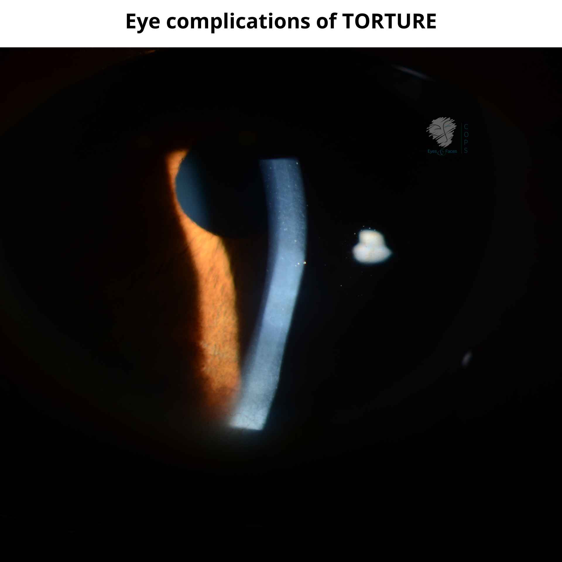 Eye complications of Torture, damaging the cornea.