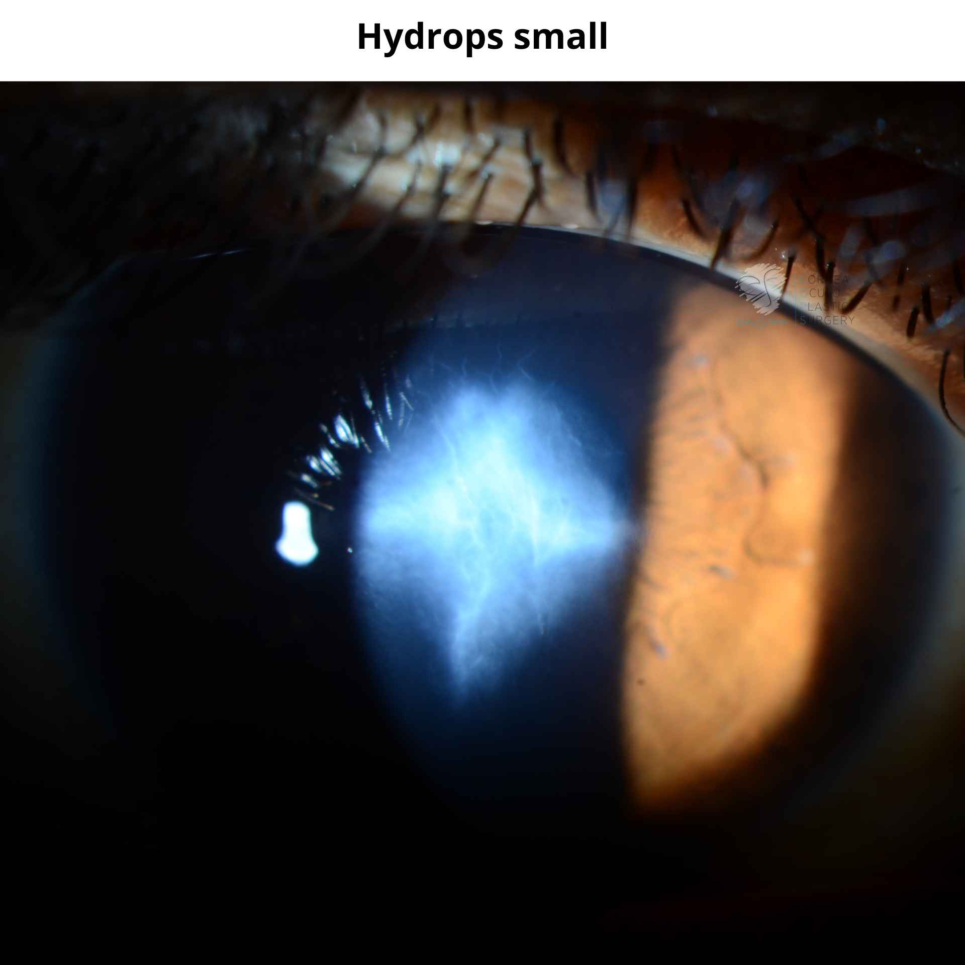 Small Hydrops as seen via a slit lamp.