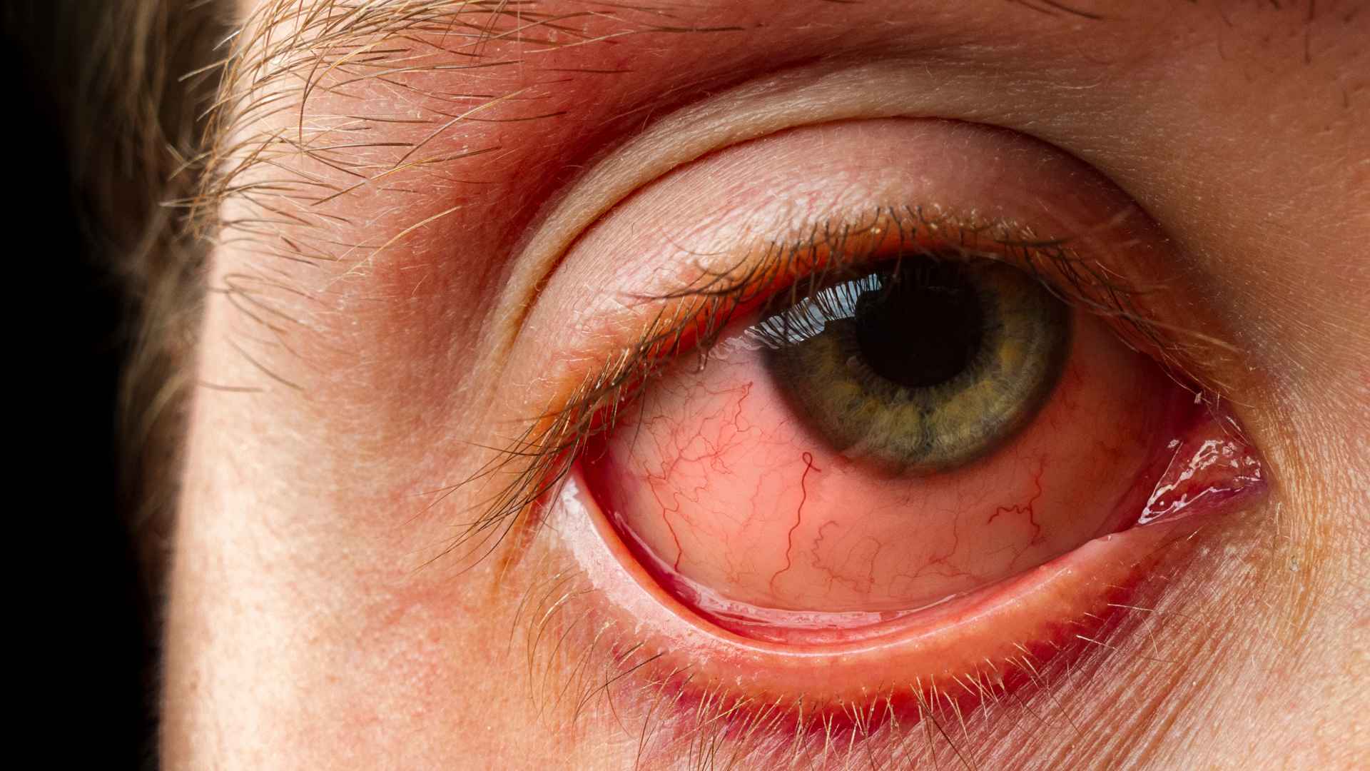 Conjunctivitis can cause a painful itchy and red eye.