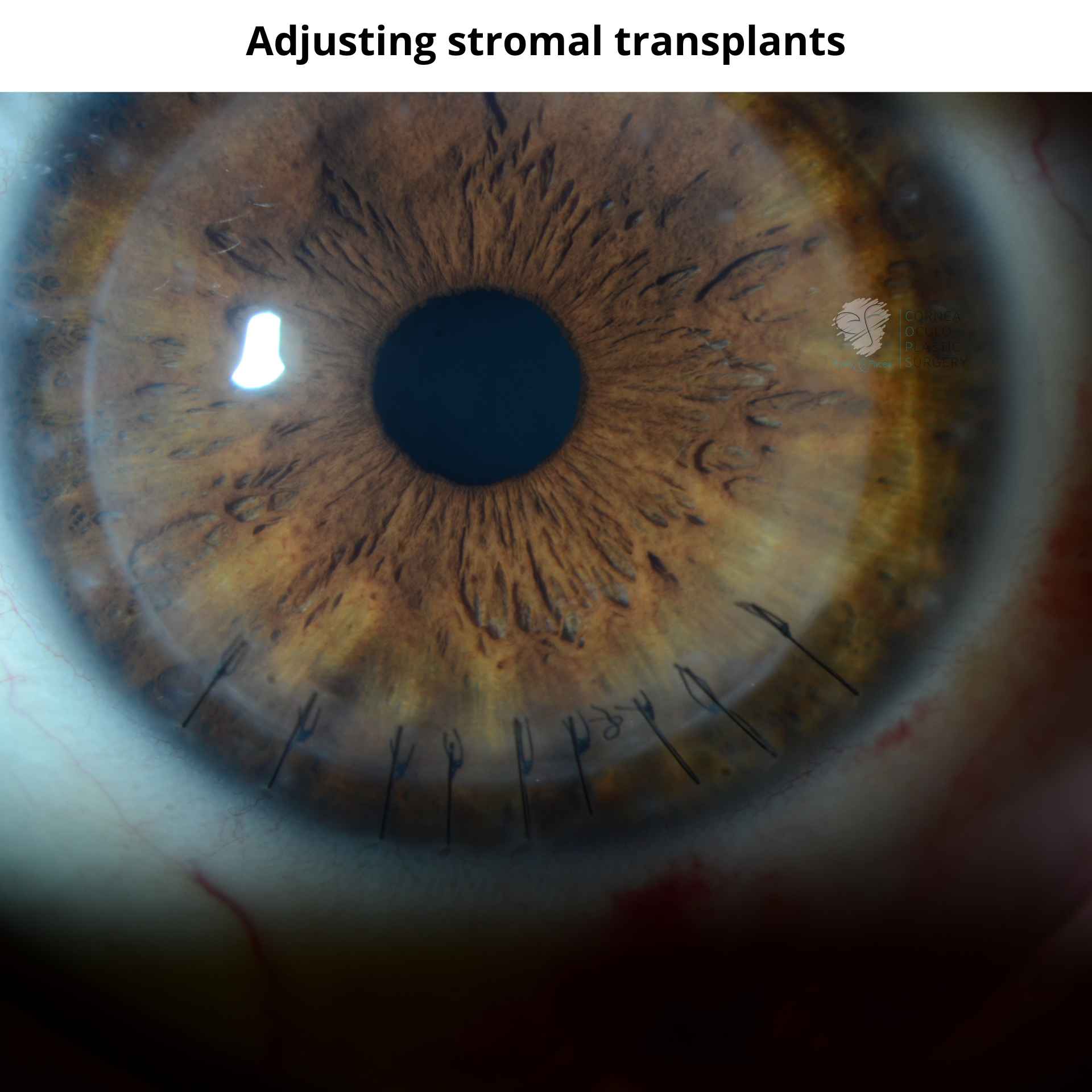 Adjusting Stromal Transplants - one zone of the eye has been resutured to combat eye rubbing.